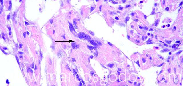 Miocarditis giant cel IV