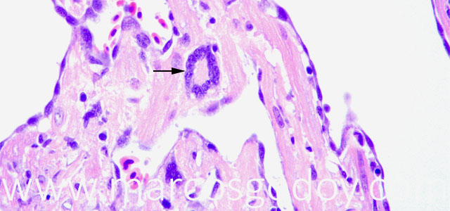 Miocarditis giant cel Ia copy