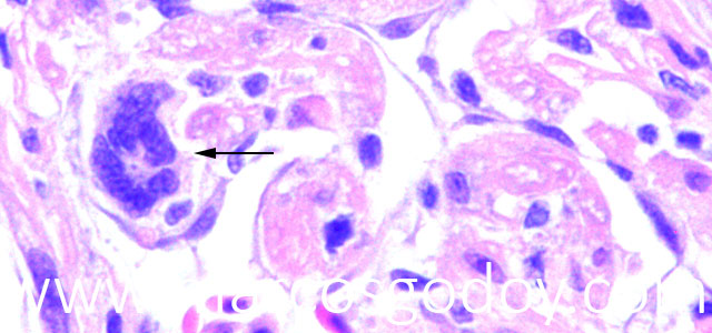 Miocarditis giant cel V