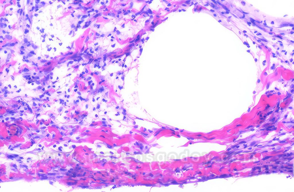 Peritonitis granulomatosa aséptica en Salmón del Atlántico (Salmo salar) I: histopatología