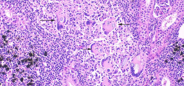 Gian cell inclussion 20X I