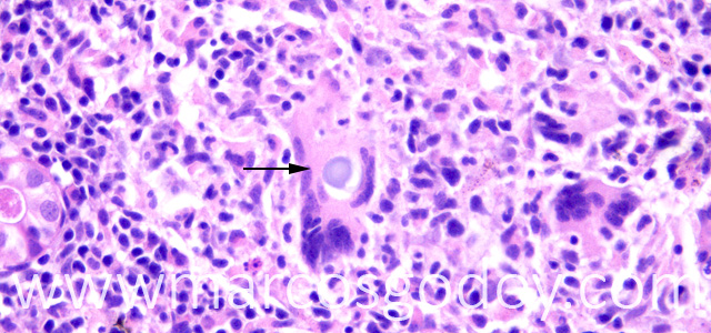 Gian cell inclussion 40X II