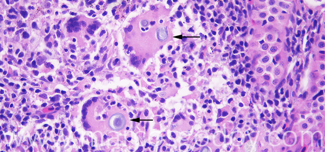 Gian cell inclussion 40X III
