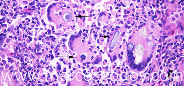 Gian cell inclussion 40X IV