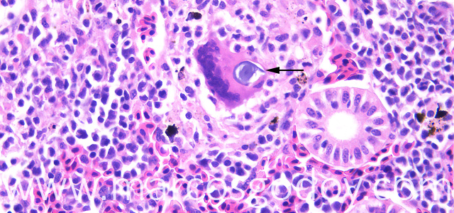 Gian cell inclussion 40X IX