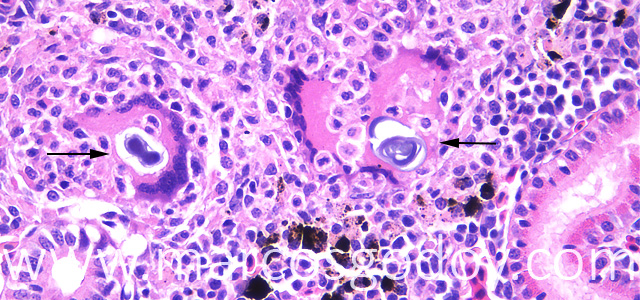 Gian cell inclussion 40X XI