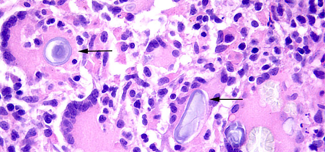 Gian cell inclussion 63X VII