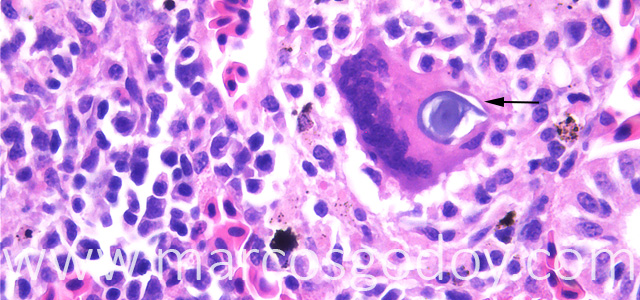 Gian cell inclussion 63X XV