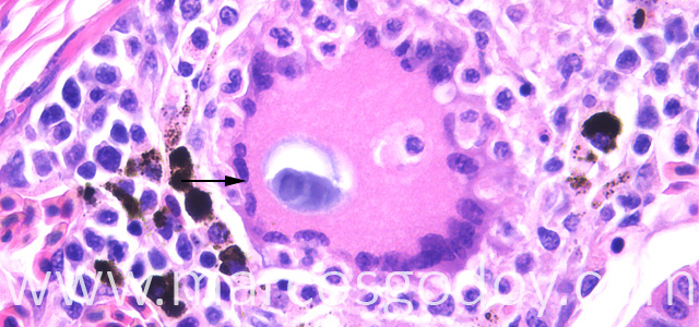 Gian cell inclussion 63X XVII