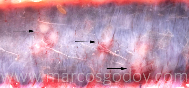 Hepatitis granulomatosa IX