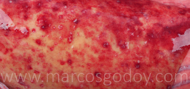 Hepatitis granulomatosa V