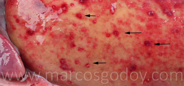 Hepatitis granulomatosa VI