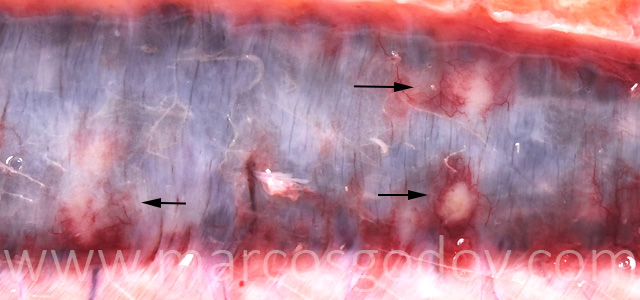 Hepatitis granulomatosa VIII