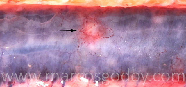 Hepatitis granulomatosa X