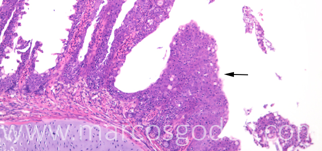 Lamellar fusion 100X VI