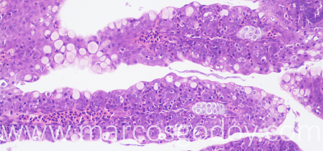 Lamellar fusion 200X VII