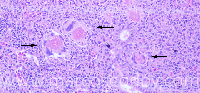 Giant cell inclusion 200X VII
