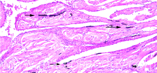 Melanosis cardiaca 100X II