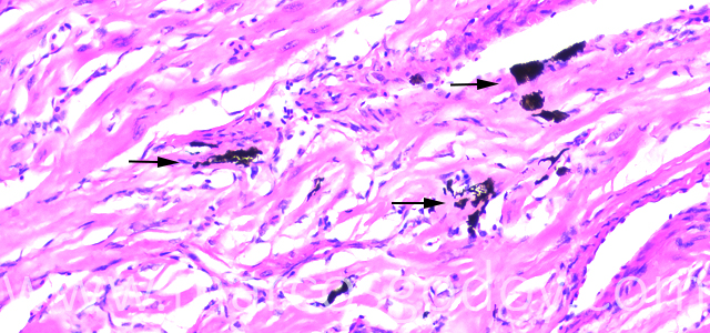 Melanosis cardiaca 200X III