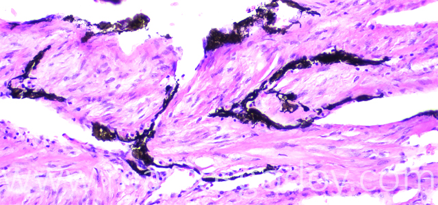 Melanosis cardiaca 400X V