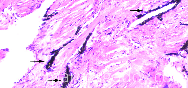 Melanosis cardicaca 400X I