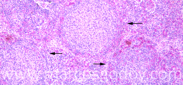 Esplenitis granulomatosa 100X IX