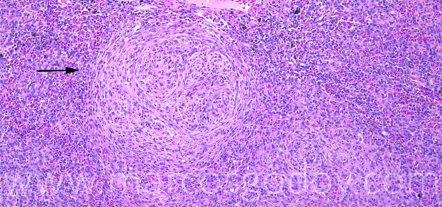 Esplenitis granulomatosa 100X V