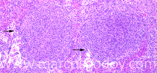 Esplenitis granulomatosa 100X VII