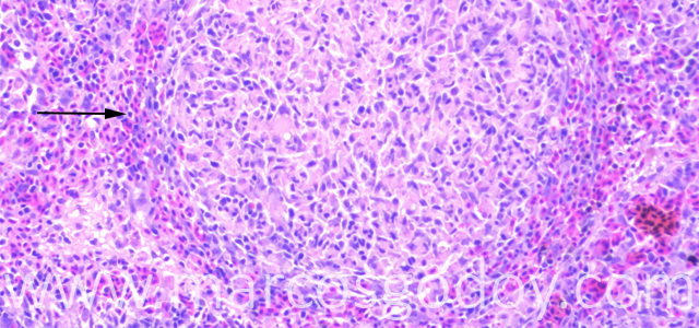 Esplenitis granulomatosa 100X X