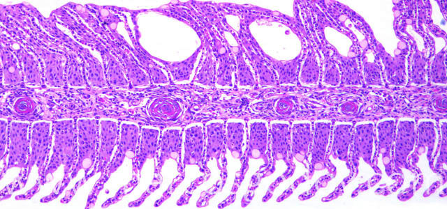 Amebiasis histo I