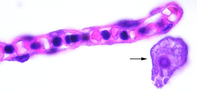 Amebiasis histo VIII