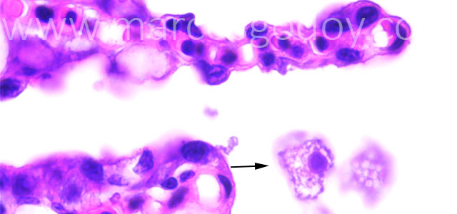 Amebiasis histo XII