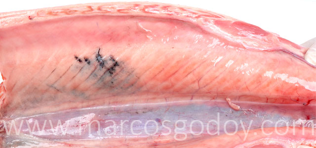 Melanosis Gross I