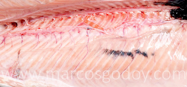 Melanosis Gross V