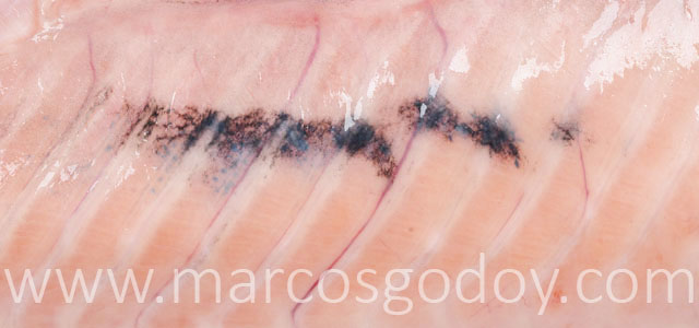 Melanosis Gross VI