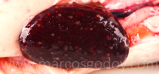 Esplenitis granulomatosa IX