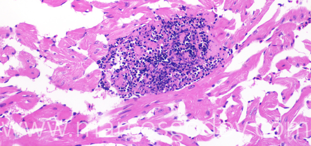 Trombosis 200X I