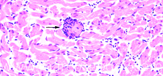 Trombosis 200X IIII