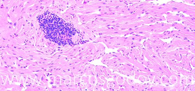 Trombosis 200X IX