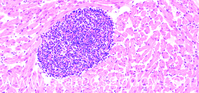 Trombosis 200X V