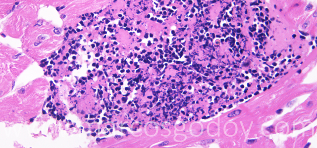 Trombosis 400X II