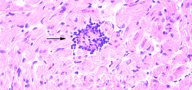 Trombosis 400X IV