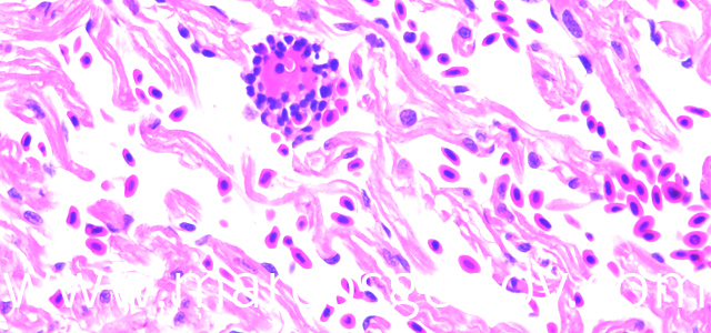 Trombosis 400X VII