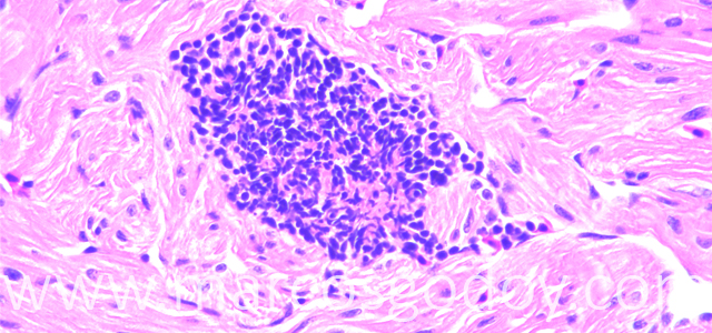 Trombosis 400X X