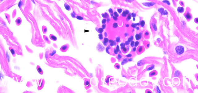 Trombosis 630X VIII
