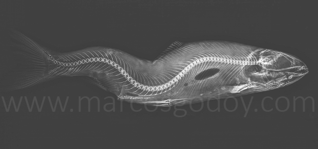 Escoliosis cifosis lordosis I