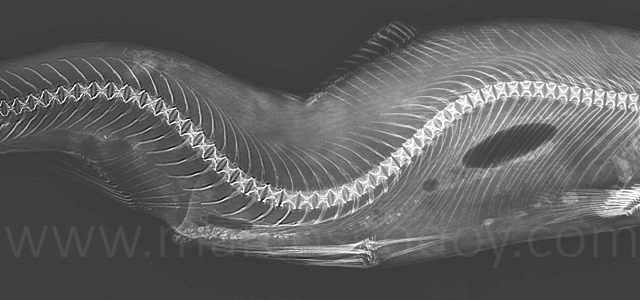 Escoliosis cifosis lordosis III