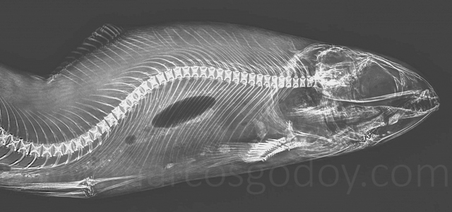 Escoliosis cifosis lordosis IV