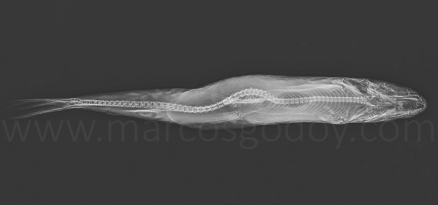 Escoliosis cifosis lordosis V