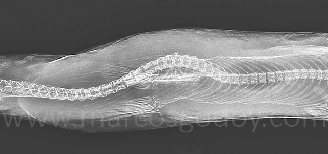 Escoliosis cifosis lordosis VI